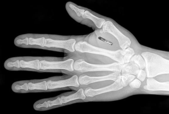 Cerca de 3 mil pessoas na Suécia implantaram chip na mão para substituir dinheiro e documentos