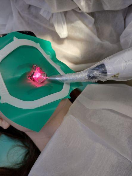 Bento passa a utilizar equipamento de ponta para tratamento de Endodontia