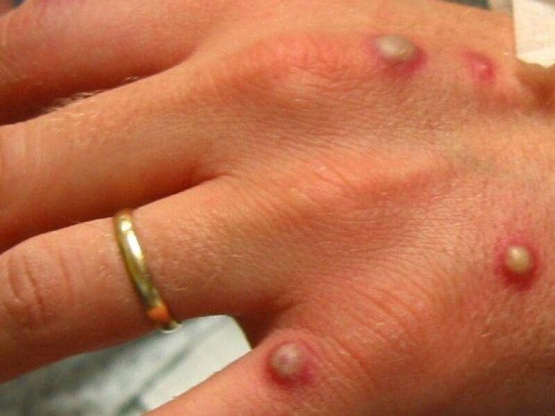 Sobe para 14 o número de casos de varíola do macaco confirmados no Brasil