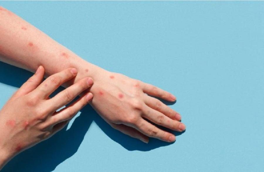 Rio Grande do Sul confirma transmissão comunitária da varíola do macaco